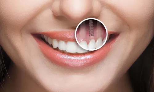 Dental implant