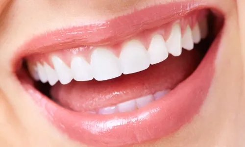Dental veneers