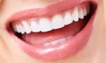 Dental veneers